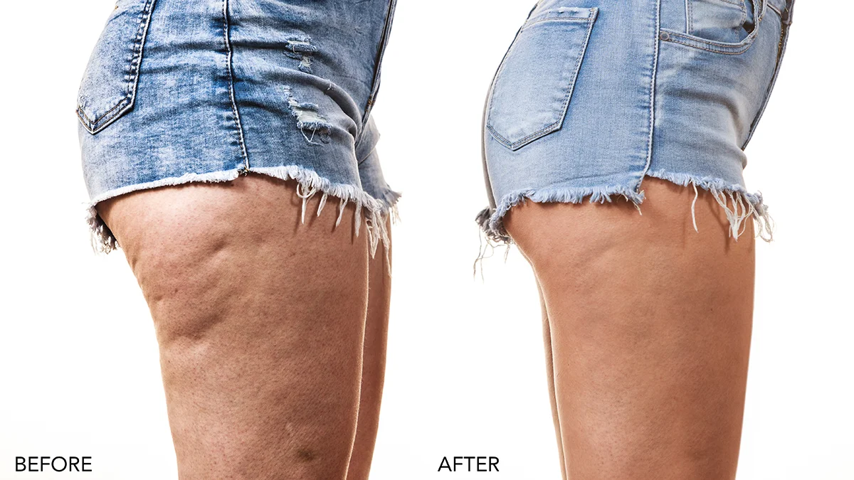 BEAR 2 body microcurrent body sculpting before and after thighs and buttocks side view in denim short pants